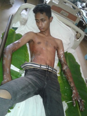 প্রেমিকার সামনে গায়ে কেরোসিন ঢেলে আগুন লাগিয়ে প্রেমিকের আত্মহত্যার চেষ্টা