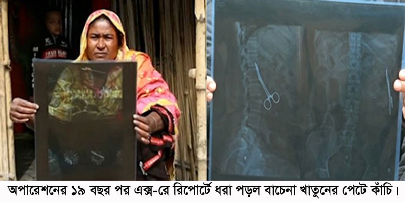 ১৯ বছর পর পেল রোগীর পেটে কাঁচি! ১৯ বছর পর পেল রোগীর পেটে কাঁচি!