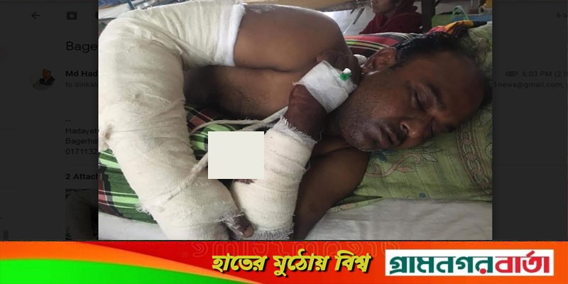 বাগেরহাটে ইউপি নির্বাচনের জের, ইউপি সদস্যকে কুপিয়ে জখম বাগেরহাটে ইউপি নির্বাচনের জের, ইউপি সদস্যকে কুপিয়ে জখম