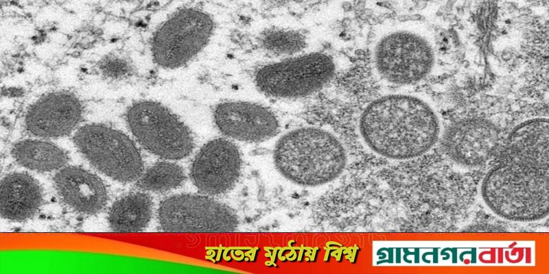 ১১ দেশে প্রায় ৮০ জন মাংকিপক্সের রোগী শনাক্ত: ডব্লিউএইচও ১১ দেশে প্রায় ৮০ জন মাংকিপক্সের রোগী শনাক্ত: ডব্লিউএইচও
