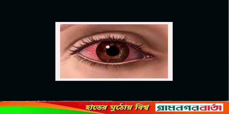 দেশের সর্বত্রই ছড়াচ্ছে চোখ ওঠা রোগ, সতর্ক থাকার পরামর্শ দেশের সর্বত্রই ছড়াচ্ছে চোখ ওঠা রোগ, সতর্ক থাকার পরামর্শ