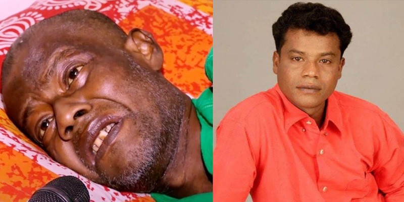 কাটতেই হলো গায়ক আকবরের পা কাটতেই হলো গায়ক আকবরের পা