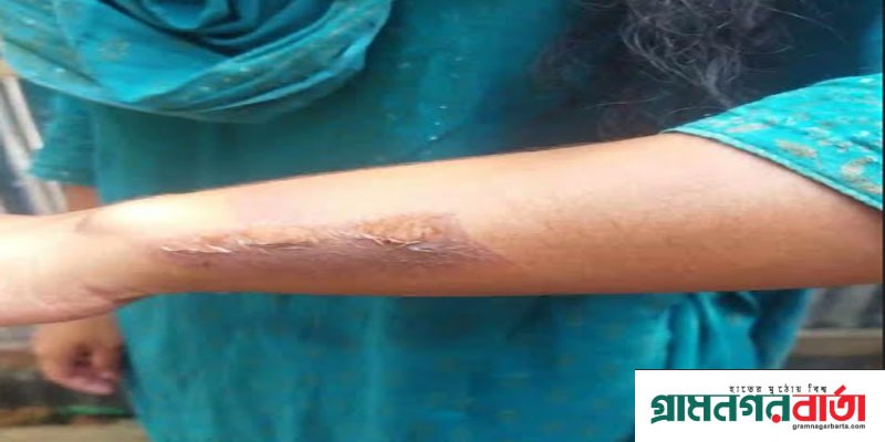 ডাসারে সৎ মায়ের খুন্তির ছেকে শিক্ষার্থী জখম ডাসারে সৎ মায়ের খুন্তির ছেকে শিক্ষার্থী জখম