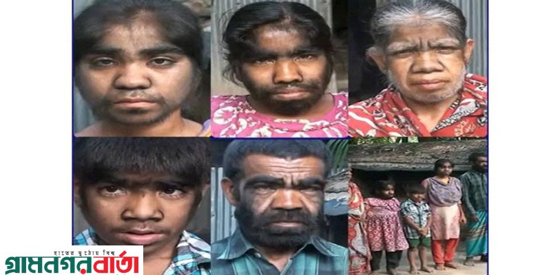 ইসলামপুরে ”লোম মানব” পরিবারের দু:খকষ্ট ইসলামপুরে ”লোম মানব” পরিবারের দু:খকষ্ট