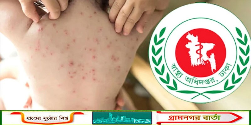 সারাদেশে হাম উপসর্গে আরও ছয় জনের মৃত্যু
