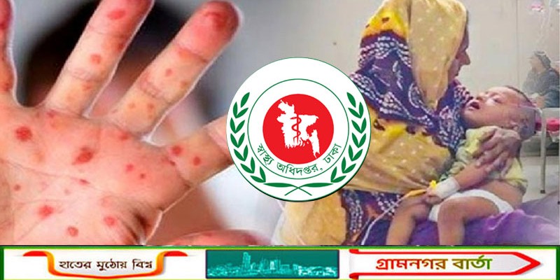 হাম রোগীদের নিয়ে স্বাস্থ্য অধিদপ্তরের পাঁচ দফা জরুরি নির্দেশনা